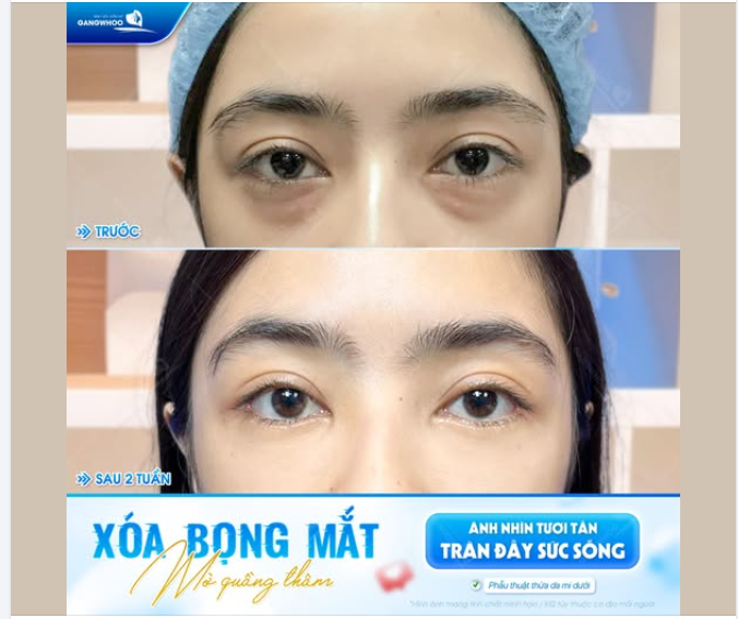 XÓA BỌNG MẮT – MỜ QUẦNG THÂM, ÁNH NHÌN TƯƠI TẮN TRỞ LẠI