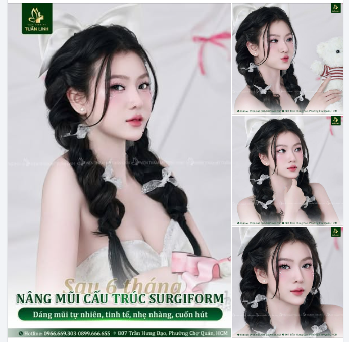 NÂNG MŨI CẤU TRÚC SURGIFORM - DÁNG MŨI SAU 6 THÁNG ĐẸP HOÀN HẢO!!