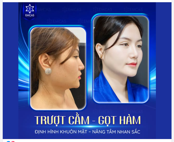 Góc hàm thon gọn, viền cằm sắc nét - Gương mặt hài hòa hơn từng đường nét