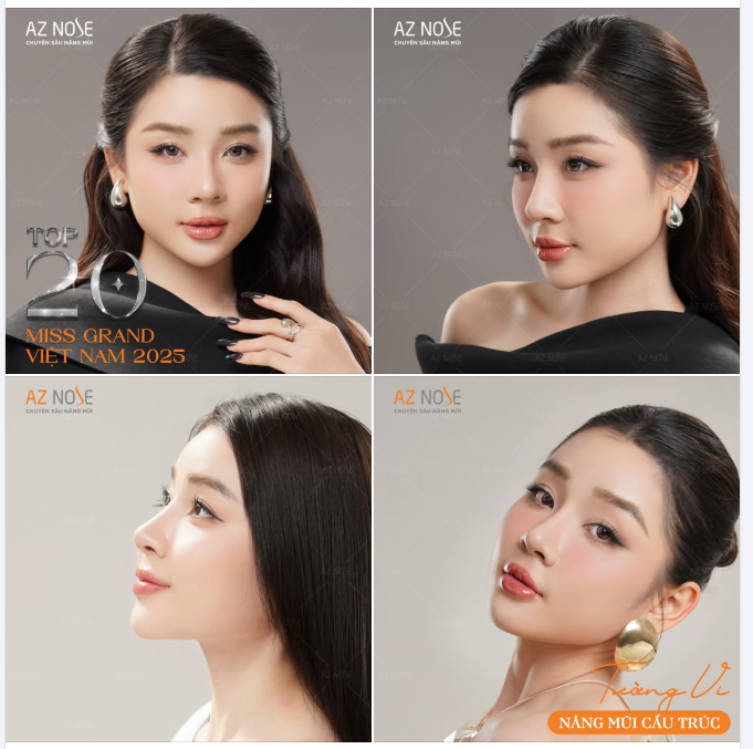 Top 20 Miss Grand Vietnam 2025 trở lại đầy thần thái sau 4 tháng nâng mũi