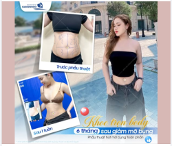 KHOE TRỌN BODY SAU 6 THÁNG GIẢM MỠ BỤNG