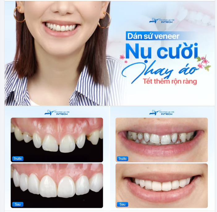 DÁN SỨ VENEER – CHO NỤ CƯỜI THAY ÁO, CHO TẾT THÊM RỘN RÀNG