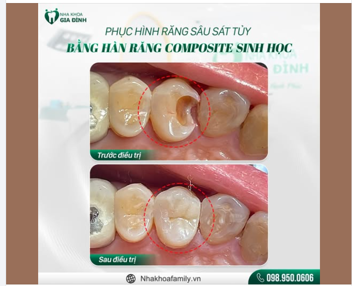 ĐIỀU TRỊ RĂNG SÂU SÁT TỦY - KHÔNG CÒN LO ĐAU NHỨC