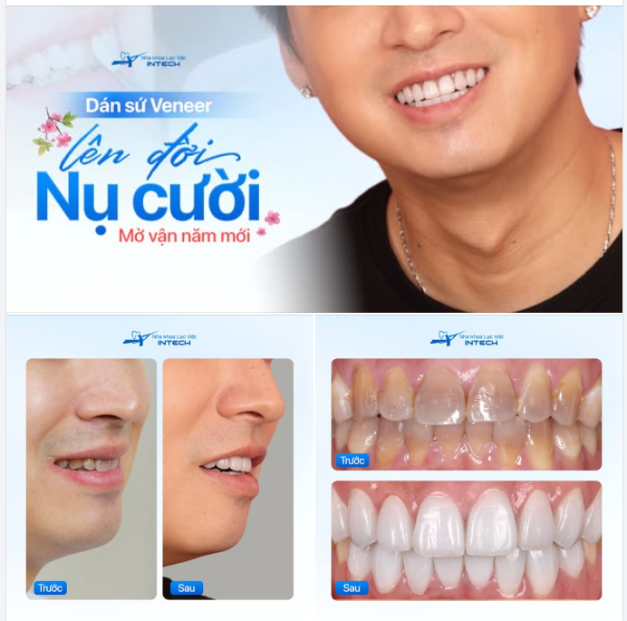 DÁN SỨ VENEER - LÊN ĐỜI NỤ CƯỜI, MỞ VẬN NĂM MỚI