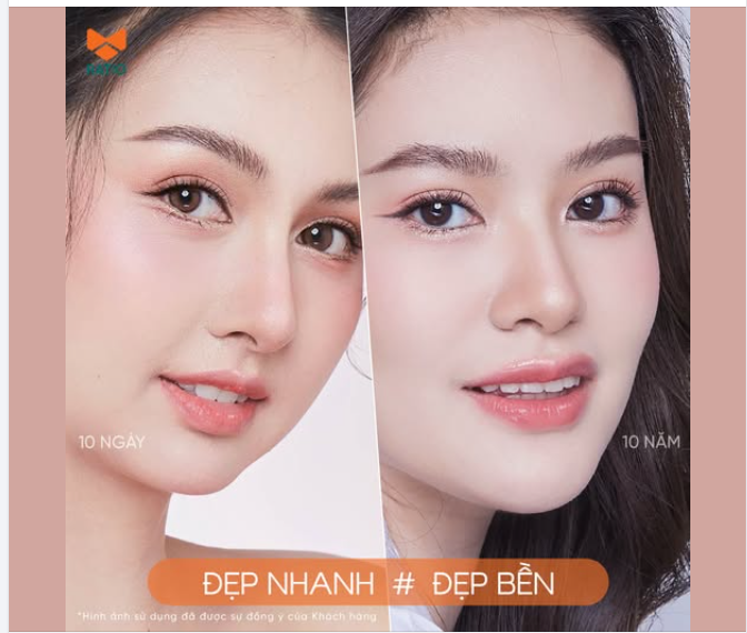 NÂNG MŨI: ĐẸP SỚM KHÁC GÌ ĐẸP BỀN?