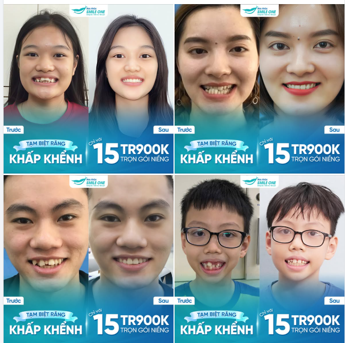 TẠM BIỆT RĂNG KHẤP KHỂNH - ĐÓN DIỆN MẠO MỚI CHỈ TỪ 15.9TR
