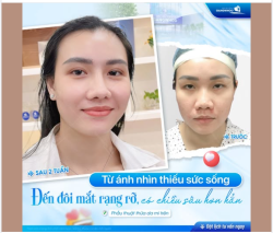 TỪ ÁNH NHÌN THIẾU SỨC SỐNG… ĐẾN ĐÔI MẮT RẠNG RỠ, CÓ CHIỀU SÂU