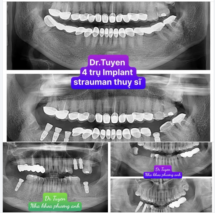 Sau khi cấy ghép implant cần kiêng gì?