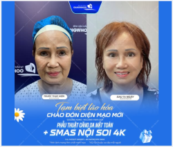 Chỉ sau 1 lần thực hiện phẫu thuật căng da mặt toàn phần + Smas nội soi 4K tại Bệnh viện thẩm mỹ Gangwhoo, Chị L - 67 tuổi ngỡ ngàng khi soi gương vì: