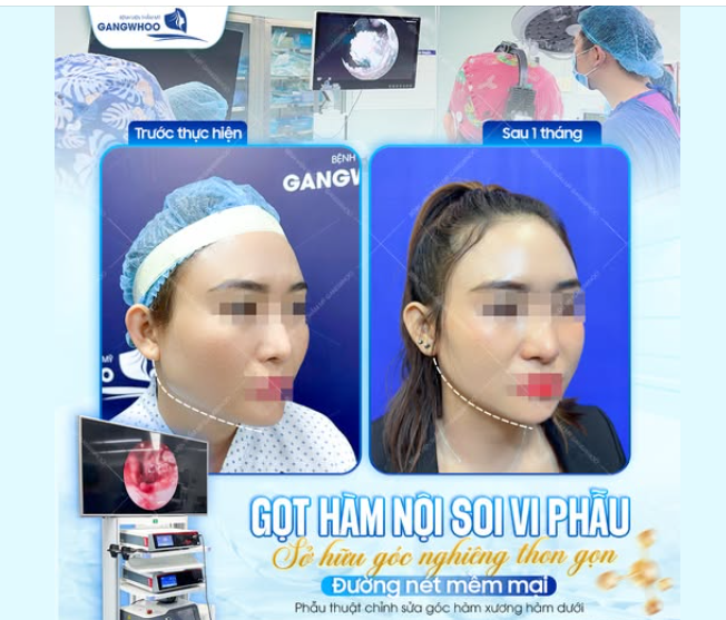 TẠO ĐƯỜNG NÉT V-LINE MỀM MẠI