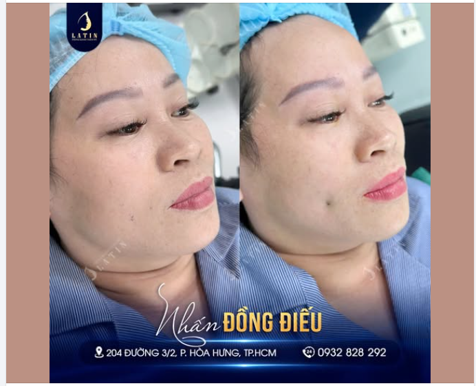 LÚM XINH NHẸ NHÀNG – GƯƠNG MẶT TRẺ RA VÀI TUỔI