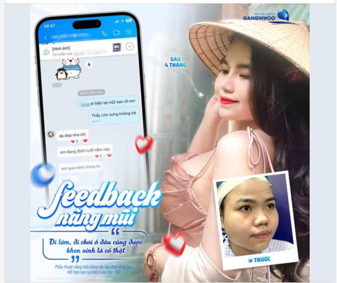 FEEDBACK SAU 4 THÁNG NÂNG MŨI