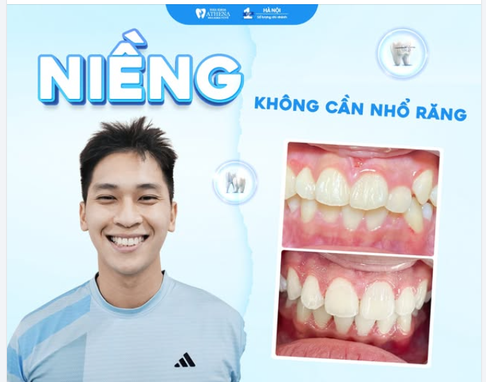 GÓC THẮC MẮC  Nhiều người khi tìm hiểu về niềng răng thường lo lắng: “Niềng có phải nhổ răng không?”