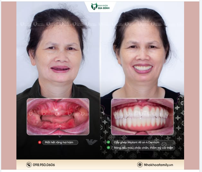 ĐỒNG HÀNH CÙNG CÔ BÙI THỊ NGHĨA TRÊN HÀNH TRÌNH TÌM LẠI NỤ CƯỜI