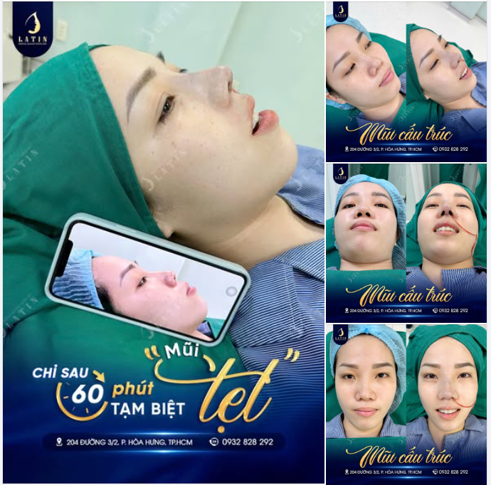 MŨI ĐẸP – AN TOÀN – GIỮ FORM BỀN LÂU VỚI NÂNG MŨI CẤU TRÚC