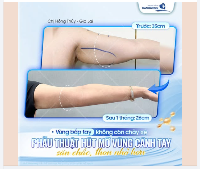 VÙNG BẮP TAY KHÔNG CÒN CHẢY XỆ