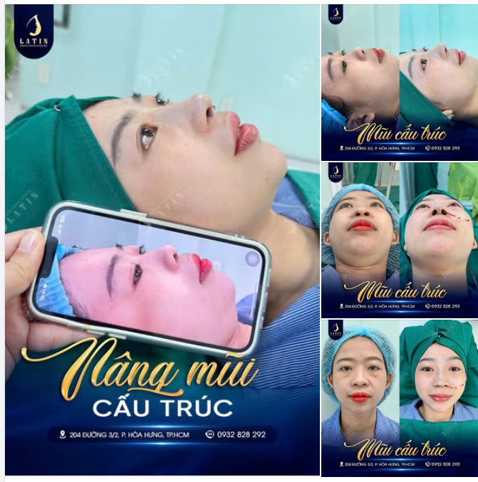 NÂNG MŨI CẤU TRÚC – GÓC NGHIÊNG ĐẸP TỰ NHIÊN