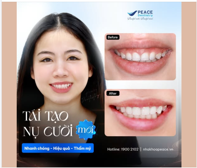 XÓA TAN KHUYẾT ĐIỂM HỞ LỢI KHI CƯỜI CHỈ SAU 1 BUỔI TẠI NHA KHOA VỚI BÁC SĨ CHUYÊN GIA