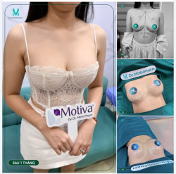 Tình trạng trước, V1 nhỏ, hơi lệch và thiếu độ đầy khiến chị khá tự ti khi diện những trang phục ôm dáng.