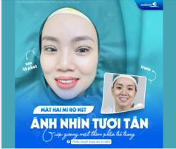 MẮT HAI MÍ RÕ NẾP – ÁNH NHÌN TƯƠI TẮN