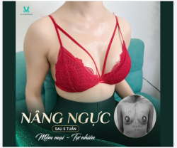 Sự thay đổi nhỏ ở vòng 1 nhưng lại mang đến sự tự tin lớn cho cả vóc dáng và thần thái.