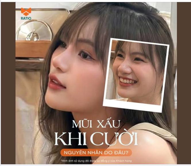 MŨI ĐẸP KHI ĐỨNG YÊN – NHƯNG CƯỜI LẠI “VỠ FORM”? NGUYÊN NHÂN NẰM Ở ĐÂU?