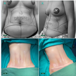 EO GỌN – DÁNG XINH CHỈ SAU MỘT LẦN THỰC HIỆN