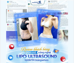 REVIEW KHÁCH HÀNG SAU GIẢM MỠ TẠI BVTM GANGWHOO