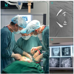 Tại Dr. Minh Phạm, mỗi ca gọt hàm đều được TS.BS Minh Phạm trực tiếp thăm khám và phân tích phim chụp X-quang/CT trước khi tiến hành phẫu thuật.