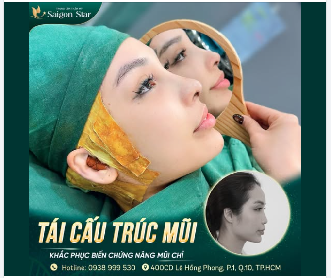 NÂNG MŨI CẤU TRÚC DR. HOẠT 60 PHÚT THÀNH CÔNG NGĂN NGỪA BIẾN CHỨNG CỦA NÂNG MŨI CHỈ!!!