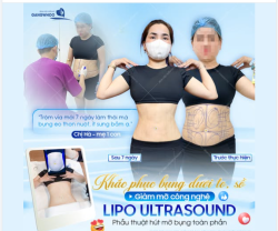 KHẮC PHỤC KHUYẾT ĐIỂM BỤNG DƯỚI