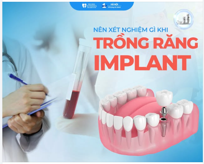 TRỒNG RĂNG IMPLANT CÓ CẦN XÉT NGHIỆM KHÔNG?