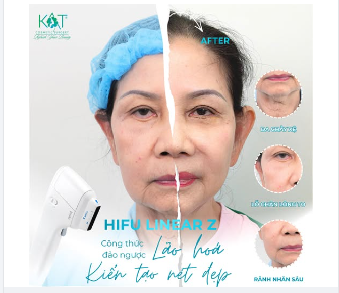 “Gucci” của công nghệ nâng cơ trẻ hóa da – gọi tên HIFU Linear Z