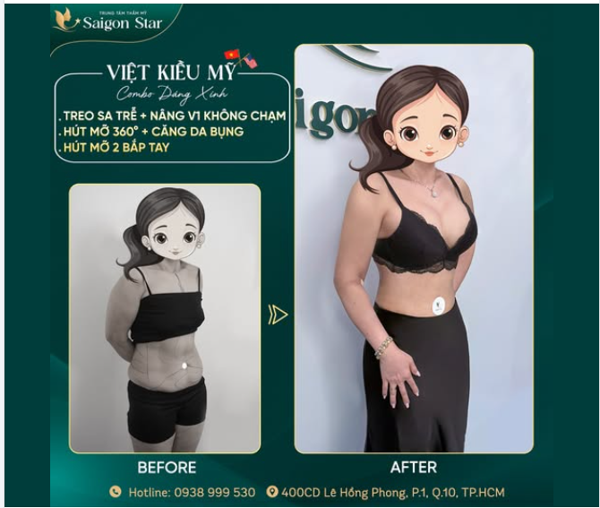 KHOE KẾT QUẢ SAU 14 NGÀY NÂNG CẤP VÓC DÁNG CỦA CHỊ KHÁCH VIỆT KIỀU MỸ