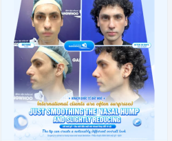 Sau 30 ngày, dáng mũi trở nên thẳng và mượt hơn, góc nghiêng rõ nét hơn nhưng không hề “giả” hay cứng. Mọi thứ thay đổi một cách rất tự nhiên.