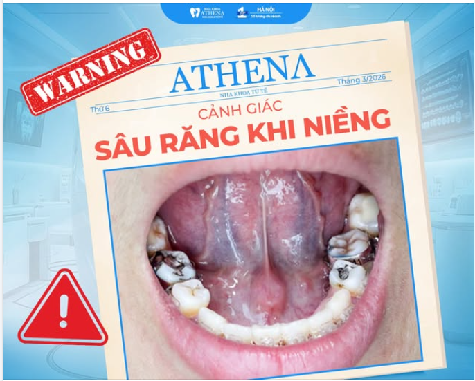 NIỀNG RĂNG NHƯNG LẠI BỊ SÂU RĂNG – NGUYÊN NHÂN DO ĐÂU?