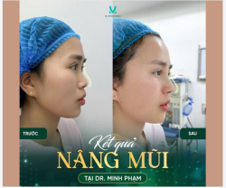 Nâng Mũi – Thay Đổi Nhẹ, Nét Đẹp Khác Biệt