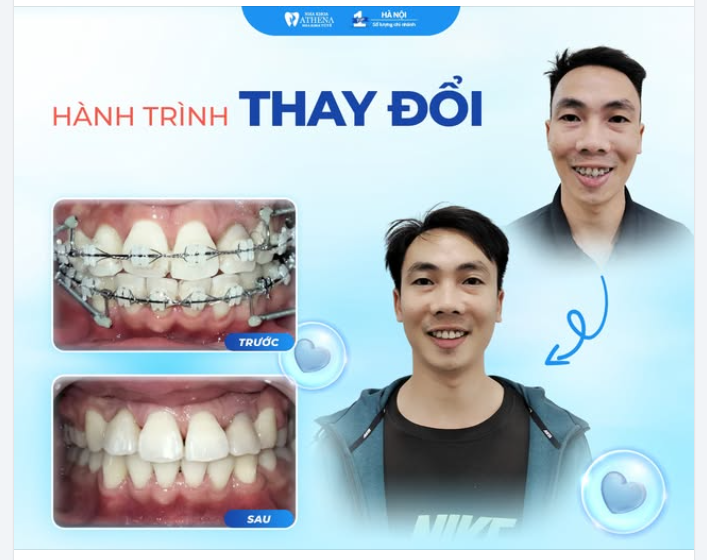 “Từ răng chen chúc, lệch lạc… đến nụ cười đều tăm tắp!
