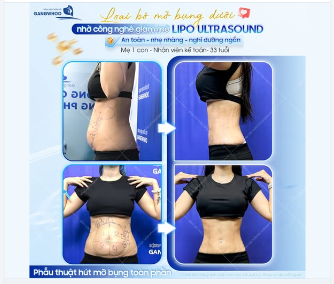 LOẠI BỎ MỠ BỤNG DƯỚI NHỜ CÔNG NGHỆ LIPO ULTRASOUND