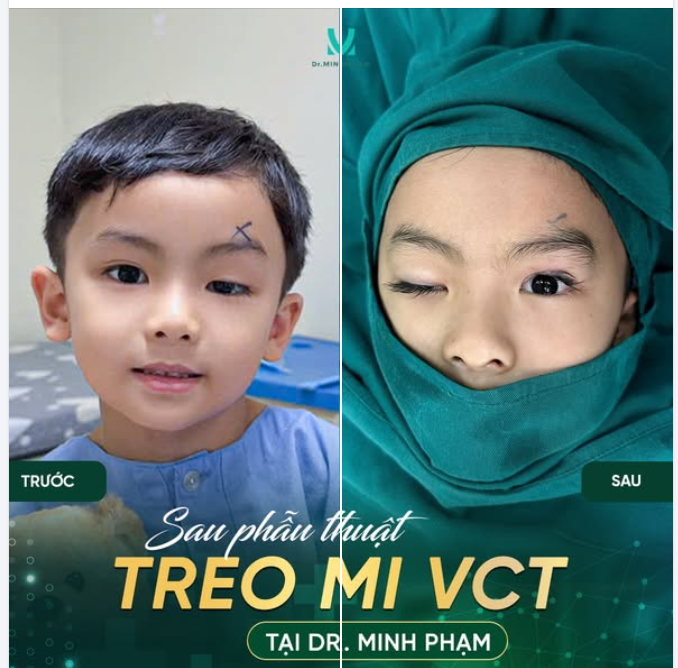 Kết quả sau phẫu thuật treo mi VCT của bé Minh Phúc