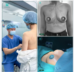 Nâng ngực – Cải thiện vóc dáng, lấy lại sự tự tin