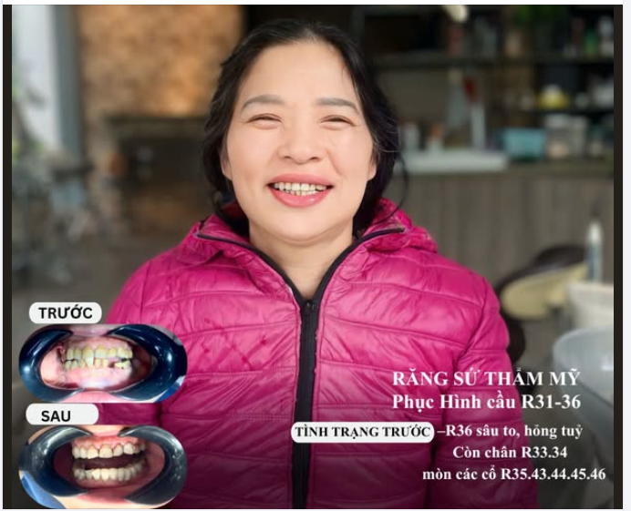 RĂNG SỨ THẨM MỸ – PHỤC HÌNH CẦU R31–36