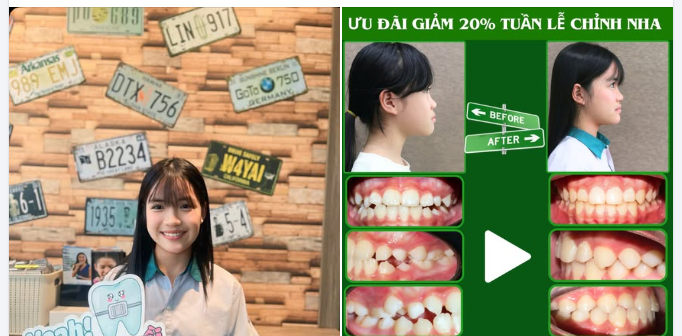 ƯU ĐÃI GIẢM 20% TUẦN LỄ CHỈNH NHA