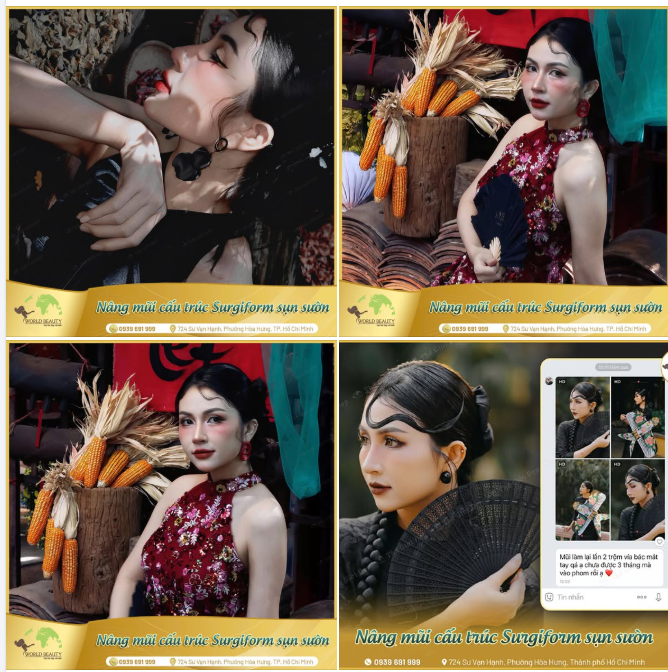 Không thể bỏ lỡ sự xinh đẹp quá ấn tượng này của quý Cô sau 1 năm n.âng cấp mũi cấu trúc Barbie-line bằng sụn s.ườn tự thân và thanh Surgiform tại Thế Giới Đẹp.