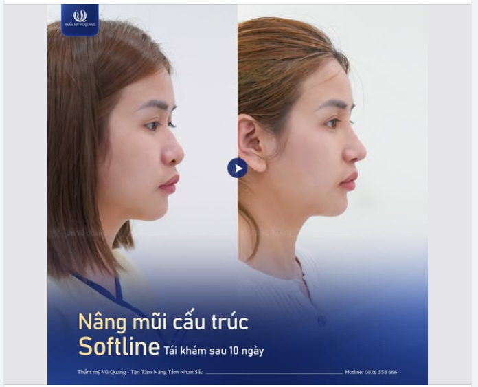 10 NGÀY TÁI KHÁM - MŨI ĐẸP CHUẨN TỈ LỆ