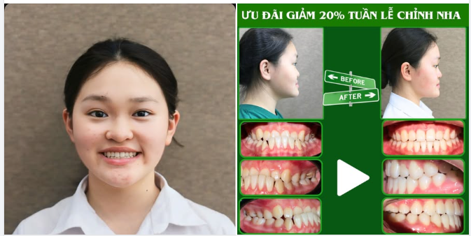 NIỀNG RĂNG – NỤ CƯỜI LÊN HẠNG- NHAN SẮC LÊN ĐỜI