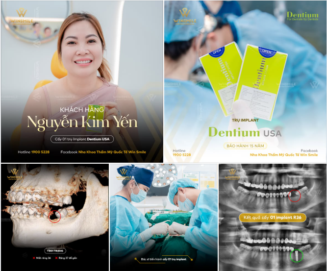 SỰ HÀI LÒNG TIẾP NỐI NIỀM TIN - GIẢI QUYẾT DỨT ĐIỂM TÌNH TRẠNG MẤT RĂNG LÂU NĂM TẠI WIN SMILE ​