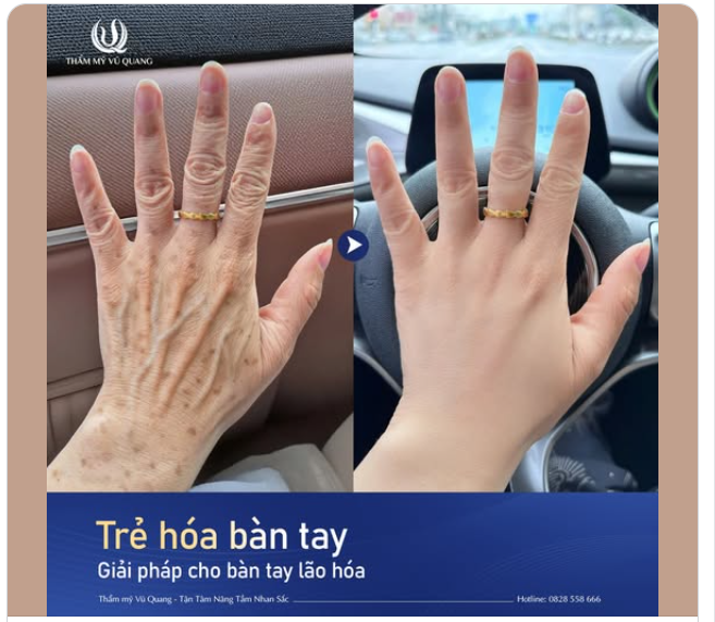 ĐỪNG ĐỂ ĐÔI TAY "TỐ CÁO" TUỔI TÁC CỦA BẠN!