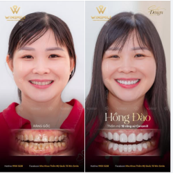 XỬ LÝ KHÉO RĂNG NHIỄM TETRACYCLINE, NỤ CƯỜI THĂNG HẠNG TỎA SÁNG