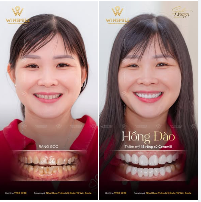 XỬ LÝ KHÉO RĂNG NHIỄM TETRACYCLINE, NỤ CƯỜI THĂNG HẠNG TỎA SÁNG